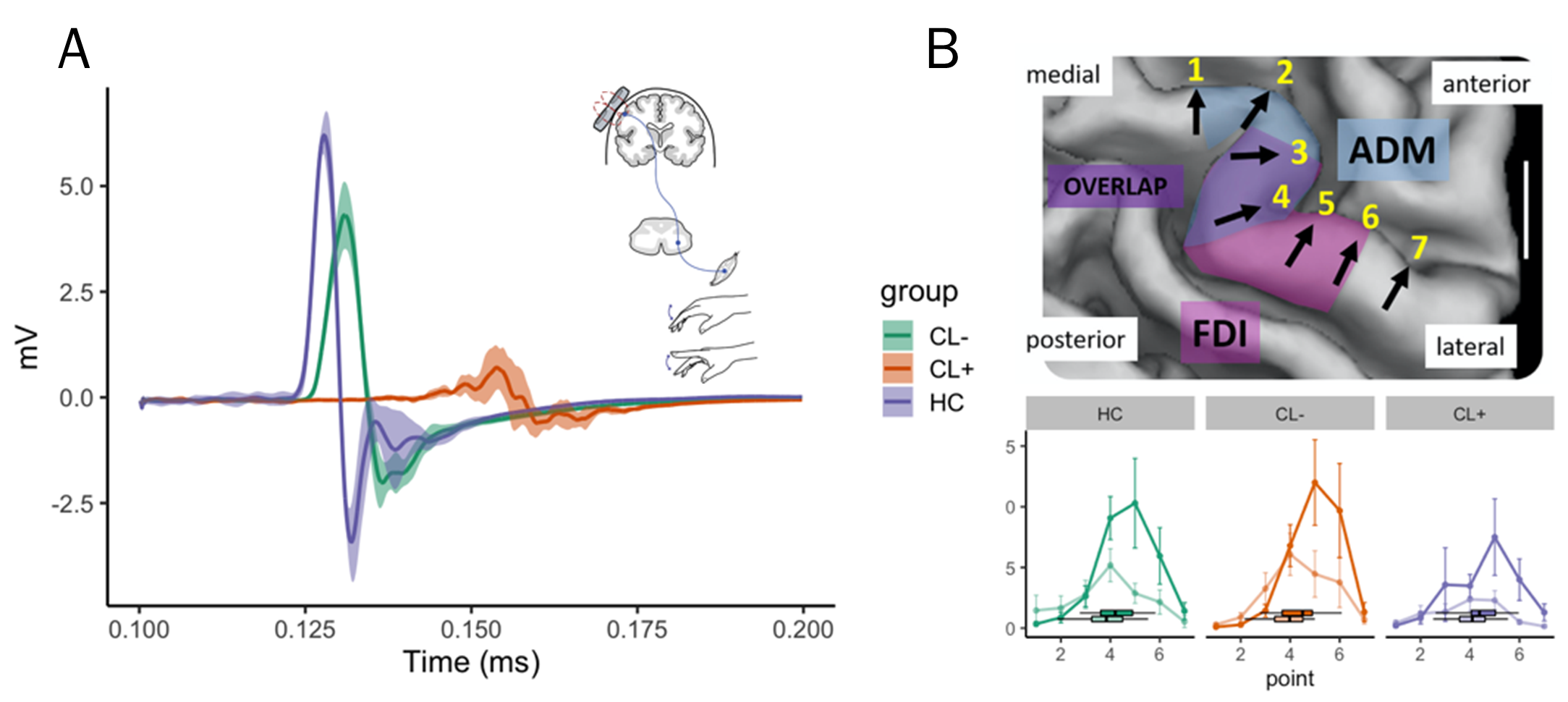 (A) The three motor evoked potentials (MEP) traces show that the onset latency was longer and lower in amplitude for both relapsing remitting MS patients compared to a healthy control (HC), but much more so in the patient with cortical damage (CL+). (B) TMS motor mapping successfully separates the representation of the FDI (bold) and ADM (faded color) muscle in all three groups.