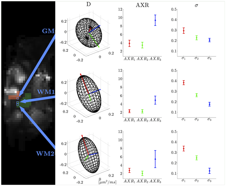 Figure 2 (Sønderby et. al. 2013): Illustration of (left) the sagittal b0 slice plane from the left hemisphere, slightly more lateral than the caudate nucleus, and (right) diffusion tensor D, AXR, and filter efficiency &sigma. Red, green, and blue indicate the first, second, and third principal directions of D, respectively. The top row illustrates tensors from a voxel in GM. The middle and bottom rows illustrate tensors from two voxels in WM. Arrows indicate voxel positions. © Wiley Periodicals, Inc.