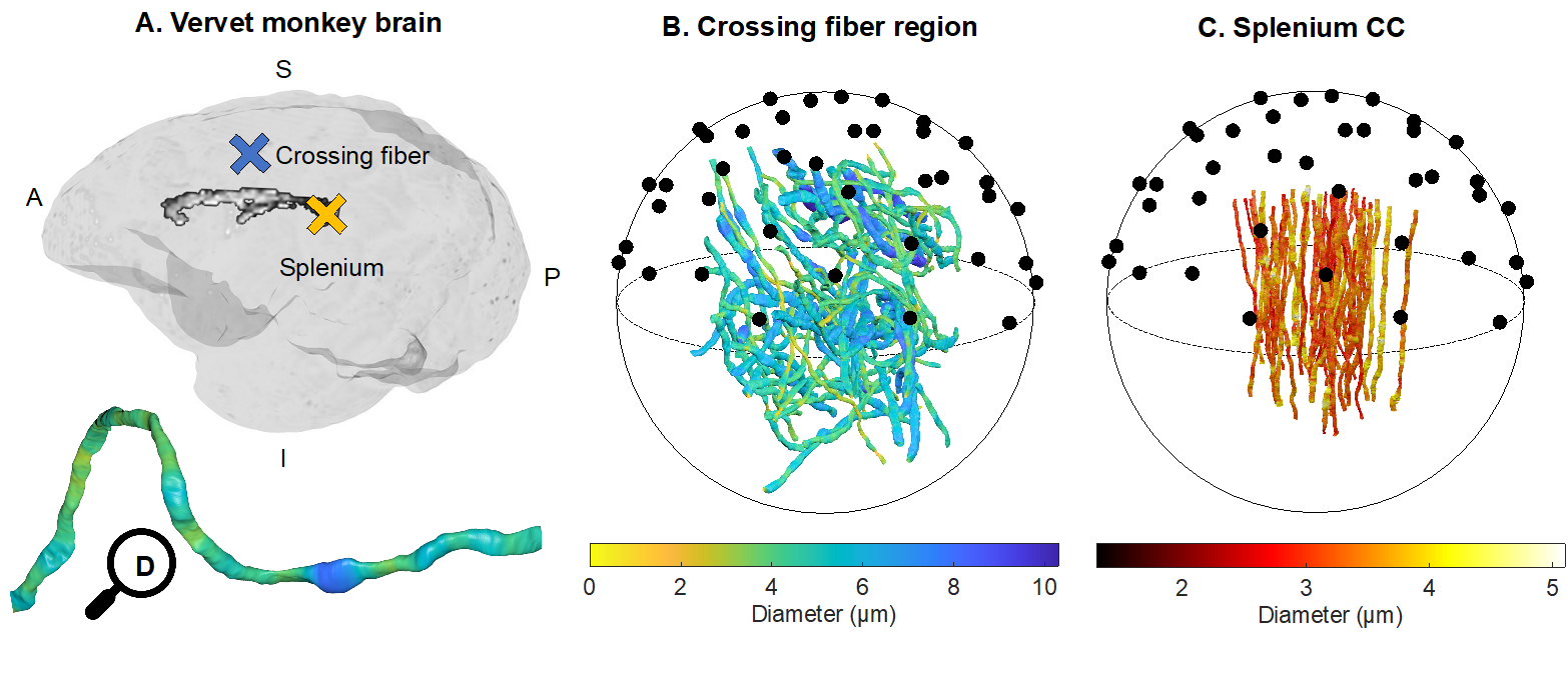 Figure 1 from Andersson et al. 2021. Can axon diameter be accurately estimated in different WM regions using PA approaches, despite complex axonal morphologies? Validation of PA-estimates of axon diameter was carried out in two different fibre architectures of the vervet monkey brain. A) Axons were segmented from XNH volumes of a heterogeneous crossing fibre region in the anterior semiovale (blue cross) and the splenium (yellow cross). B) 58 segmented crossing fibre axons and C) 54 segmented splenium axons from Andersson et al. (2020). The axon diameters are indicated by the respective colorbars and the black circles represent uniformly distributed directions on the unit sphere. D) A magnified view of one of the axons from B, showing its trajectory and diameter variations.