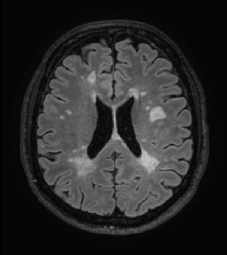 Axial Magnetic Resonance Image (MRI) showing characteristic disease-related white matter alterations in a patient with multiple sclerosis